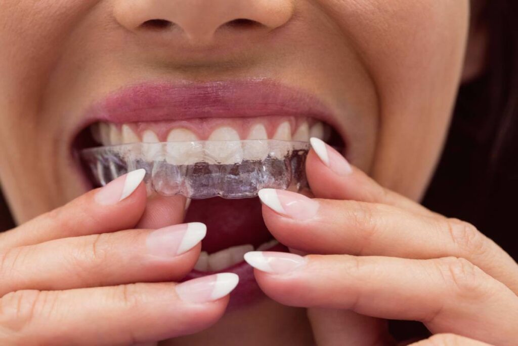 La férula dental no soluciona el bruxismo, sólo trata el desgaste dental